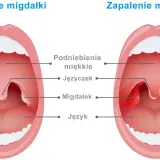 Porównanie zdrowych migdałków z powiększonymi i zaczerwienionymi migdałkami w zapaleniu.