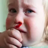 Małe dziecko z krwią z nosa, płacze. Krwawienie z nosa u dziecka jest częste.