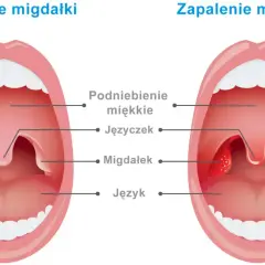 Porównanie zdrowych migdałków z powiększonymi i zaczerwienionymi migdałkami w zapaleniu.