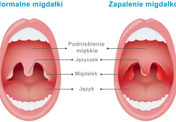 Porównanie zdrowych migdałków z powiększonymi i zaczerwienionymi migdałkami w zapaleniu.
