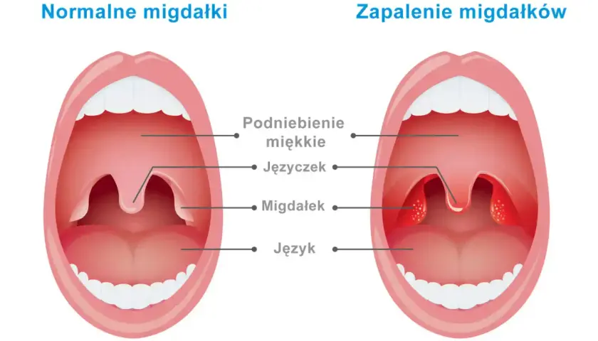 Porównanie zdrowych migdałków z powiększonymi i zaczerwienionymi migdałkami w zapaleniu.