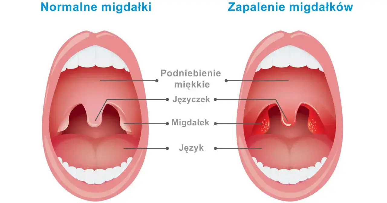Porównanie zdrowych migdałków z powiększonymi i zaczerwienionymi migdałkami w zapaleniu.