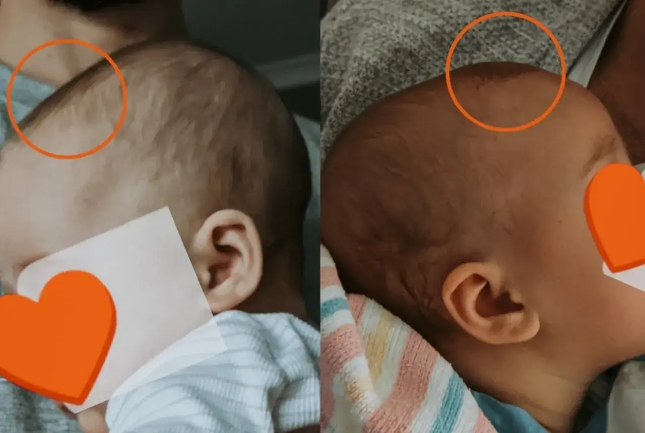 Dwa ujęcia główki niemowlaka, pokazujące postęp w zrastaniu się ciemiączka.
